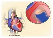 How abnormal heart valves can cause heart failure