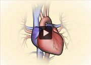 How a heart attack can cause heart failure